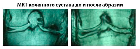 MRT коленного сустава до и после абразии
