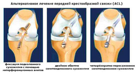 Лечение разрыва передней связки колена